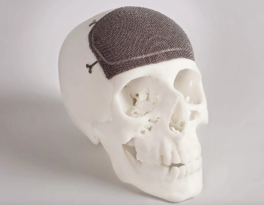 EBM 3D printed skull implant