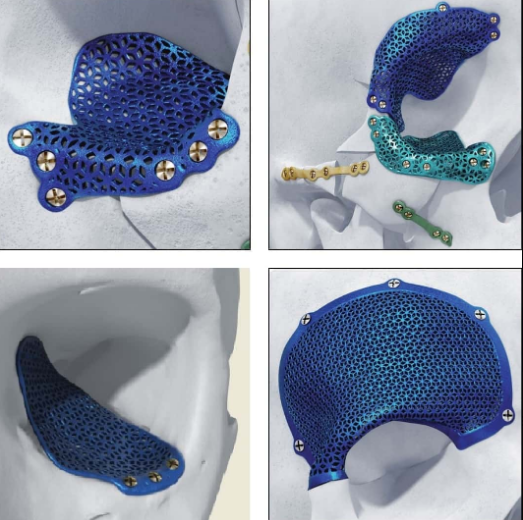 MRI-Compatible Implants